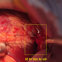 Bệnh viện Nhân dân Gia Định phẫu thuật thành công bệnh nhân vỡ tim và ngưng tim