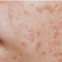 Virus HPV lây qua đường tình dục có thể gây ra những bệnh nào?