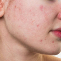 Điều bạn cần biết về mụn trứng cá đỏ?