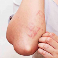 5 dấu hiệu cảnh báo bạn nhiễm giun sán