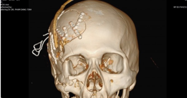 Bác sĩ Việt Nam cứu thành công một bệnh nhân người Philippines bị vỡ sọ