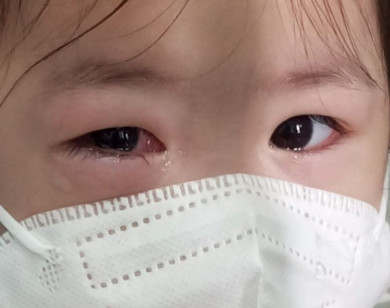 Sở Y tế TP Hồ Chí Minh báo động nguy cơ dịch đau mắt đỏ