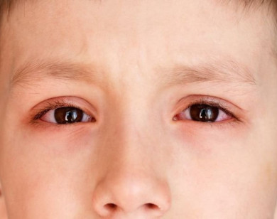 Nhìn vào mắt người mắc bệnh đau mắt đỏ sẽ bị lây?