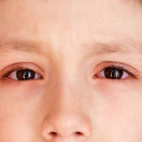 Nhìn vào mắt người mắc bệnh đau mắt đỏ sẽ bị lây?