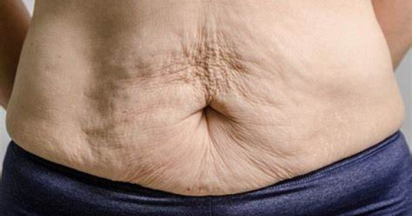 6 mẹo ngăn da chảy xệ sau giảm cân bạn nên biết