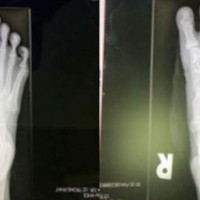 Phát hiện và điều trị cơ xương khớp từ sớm để bảo vệ sức khỏe