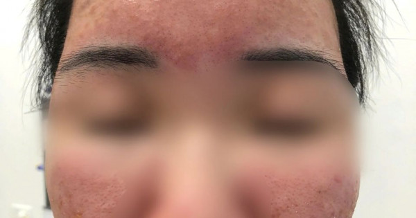 Hỏng da vì dùng kem "SPF 70 siêu chống nắng" mua trên mạng