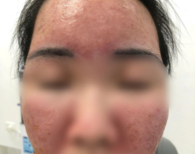 Hỏng da vì dùng kem "SPF 70 siêu chống nắng" mua trên mạng