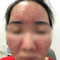 Hỏng da vì dùng kem 