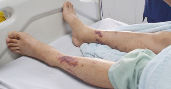 Số ca mắc liên cầu lợn tăng bất thường, cần làm gì để phòng tránh?