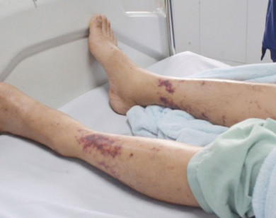 Số ca mắc liên cầu lợn tăng bất thường, cần làm gì để phòng tránh?