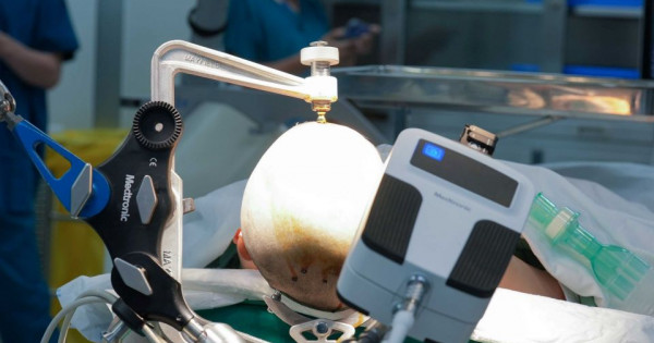 Vinmec tiên phong điều trị động kinh bằng Robot định vị thần kinh hàng đầu thế giới
