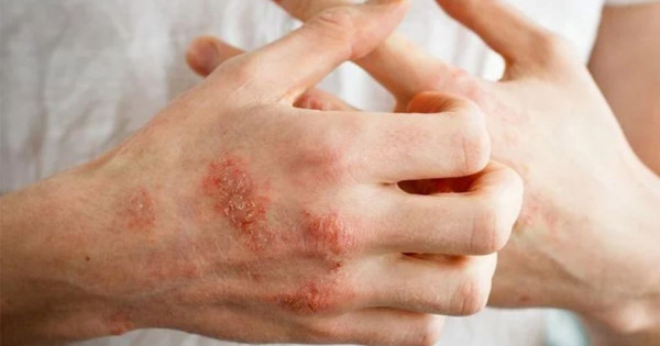 Cách điều trị và phòng ngừa bệnh ghẻ trong mùa mưa bão, lũ lụt
