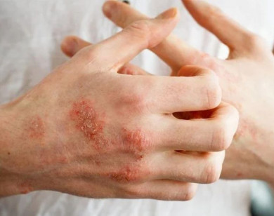 Cách điều trị và phòng ngừa bệnh ghẻ trong mùa mưa bão, lũ lụt