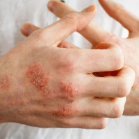 Cách điều trị và phòng ngừa bệnh ghẻ trong mùa mưa bão, lũ lụt