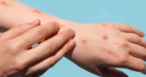 Bổ sung 12 bệnh vào danh mục bệnh truyền nhiễm nhóm A, B