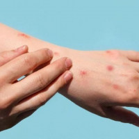 Bổ sung 12 bệnh vào danh mục bệnh truyền nhiễm nhóm A, B