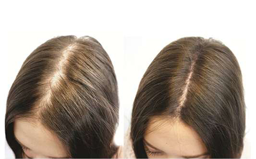 Chữa rụng tóc cực hiệu quả từ khế chua