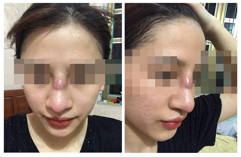 ảnh mũi người bệnh trước khi nhập viện điều trị
