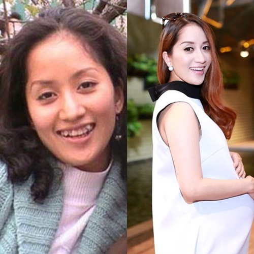 Những sao nữ Việt trở nên xinh đẹp hơn nhờ “thẩm mỹ răng”