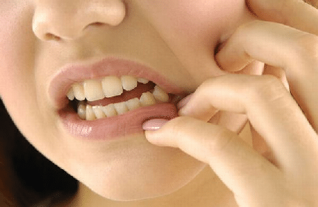 sâu răng 