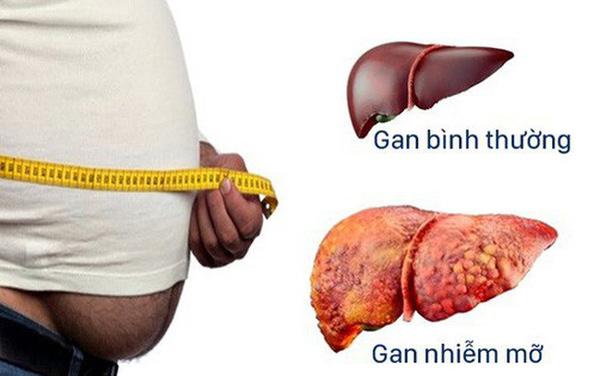 gan nhiễm mỡ 