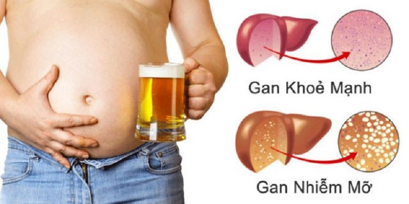 gan nhiễm mỡ 