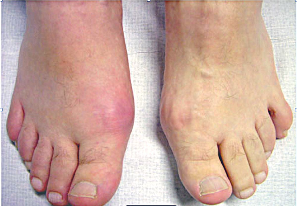 bệnh gout