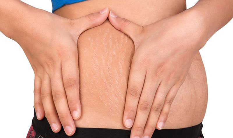 Rạn da và cách ngăn ngừa hiệu quả