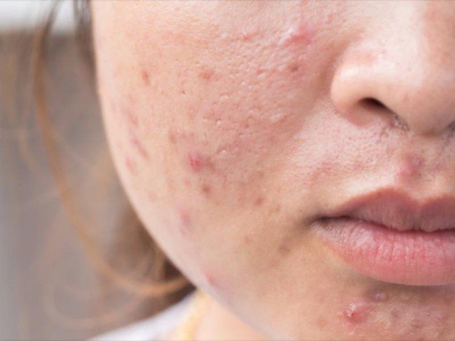 3 công thức trị mụn trứng cá ở nhà siêu dễ
