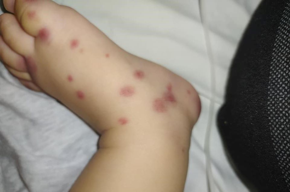 Bé 6 tháng tuổi mắc bệnh cực hiếm, lần đầu ghi nhận tại Việt Nam