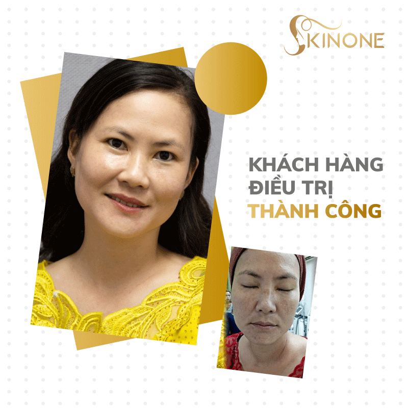 Phòng khám da liễu SkinOne: Điều trị nám bằng công nghệ cao