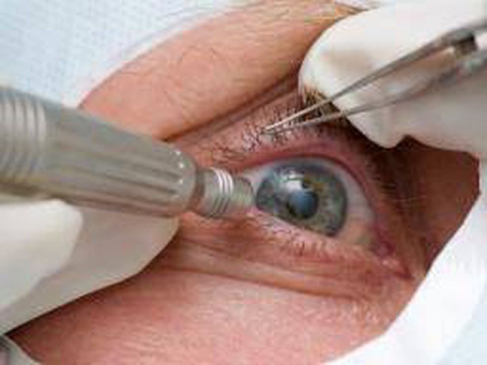 Mắt bị mù vĩnh viễn sau phẫu thuật đục thủy tinh thể tại Bệnh viện mắt Việt Nhật 