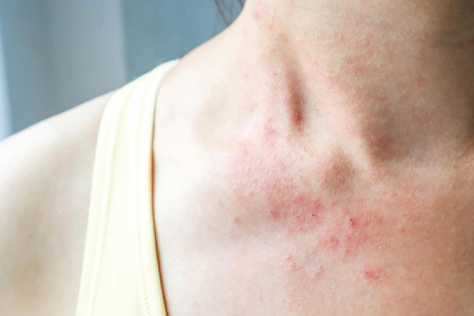 4 bệnh về da thường gặp vào mùa đông và cách phòng tránh
