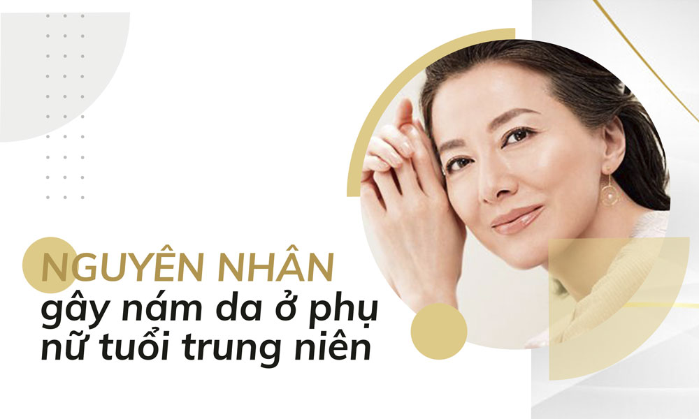 Nám da tuổi trung niên – Đâu thực sự là phương pháp điều trị hiệu quả?