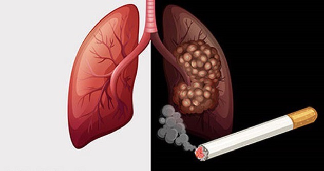 Thanh lọc phổi dành riêng cho người hút thuốc lá