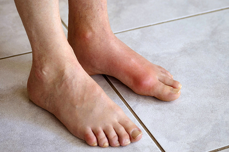 Người bị bệnh gout nên ăn gì?