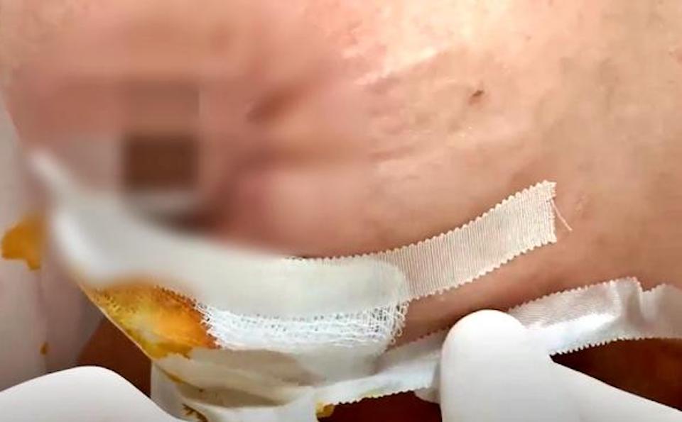 Cơ sở thẩm mỹ "chui" bỏ quên gạc y tế trong ngực khiến bệnh nhân nguy kịch