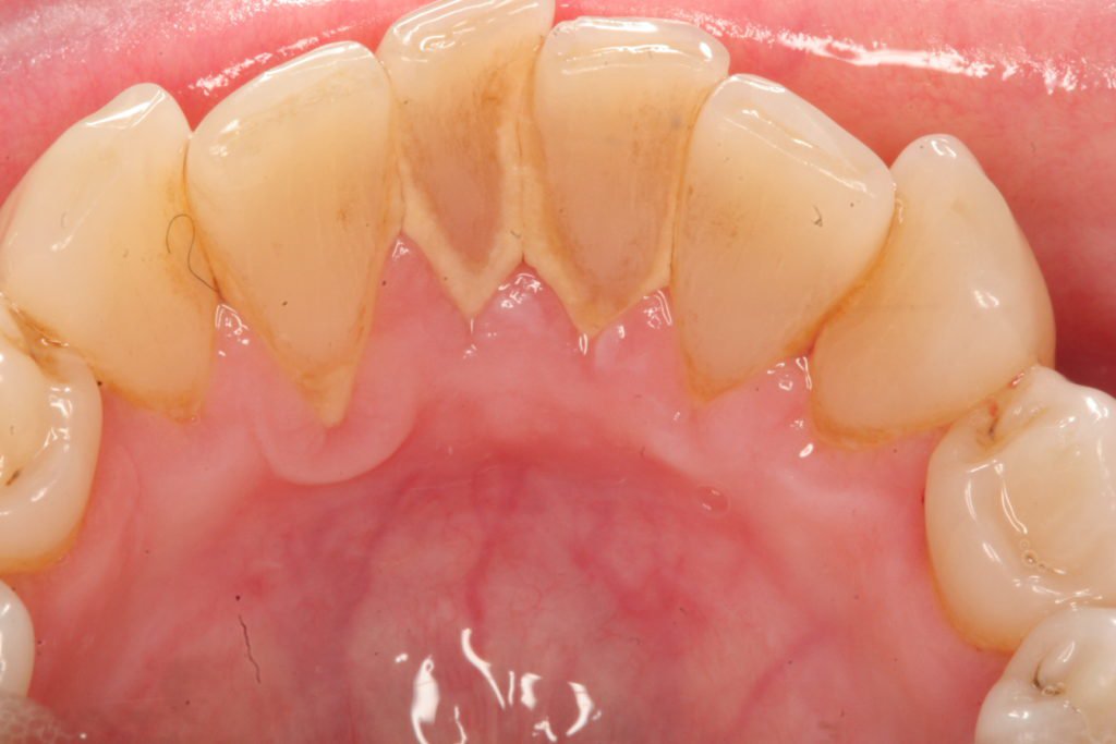 3 quan niệm sai lầm về lấy cao răng