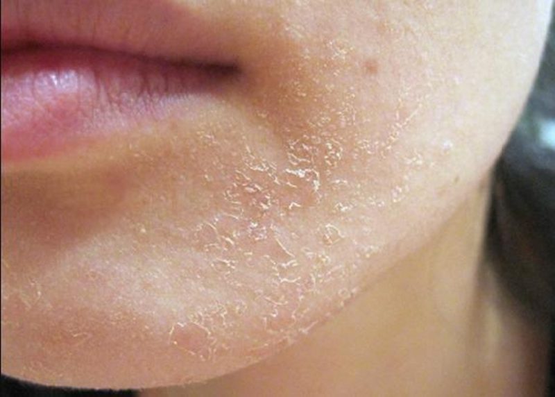 Da khô dùng mặt nạ nào cải thiện nhanh?