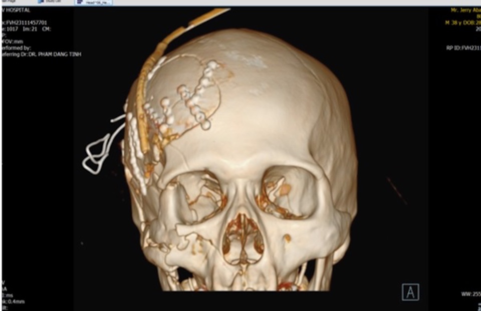 Bác sĩ Việt Nam cứu thành công một bệnh nhân người Philippines bị vỡ sọ