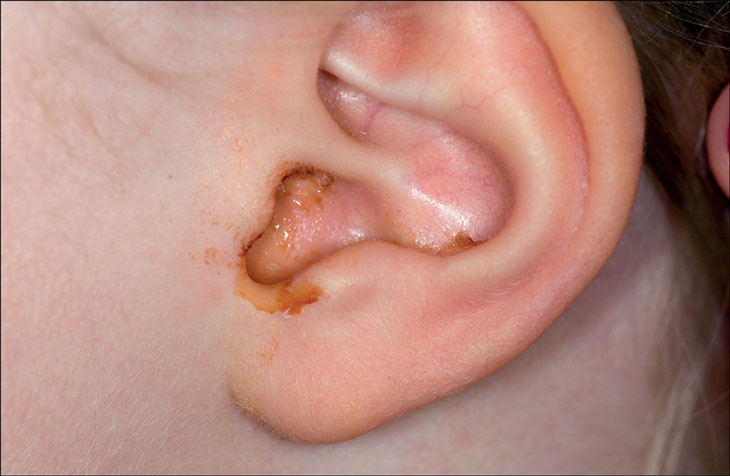 Cách vệ sinh tai cho trẻ bị viêm tai giữa 