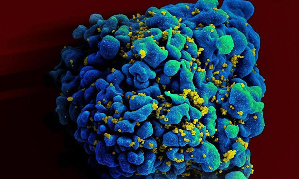 Thêm một người trên thế giới được chữa khỏi HIV