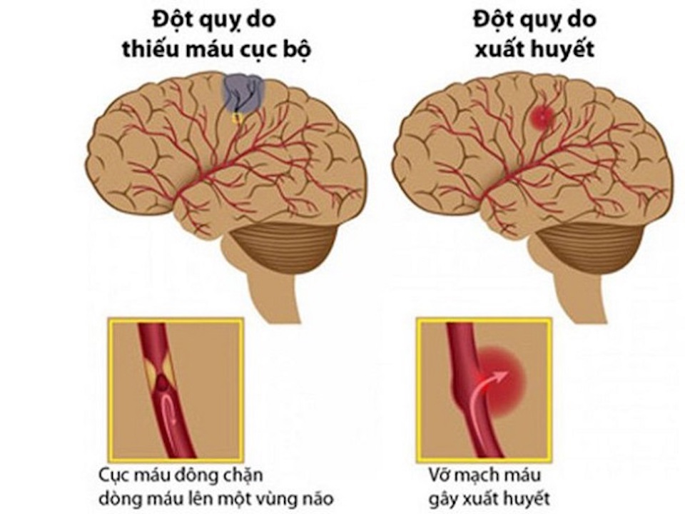 Phòng đột quỵ bằng thuốc đông y Vạn Xuân