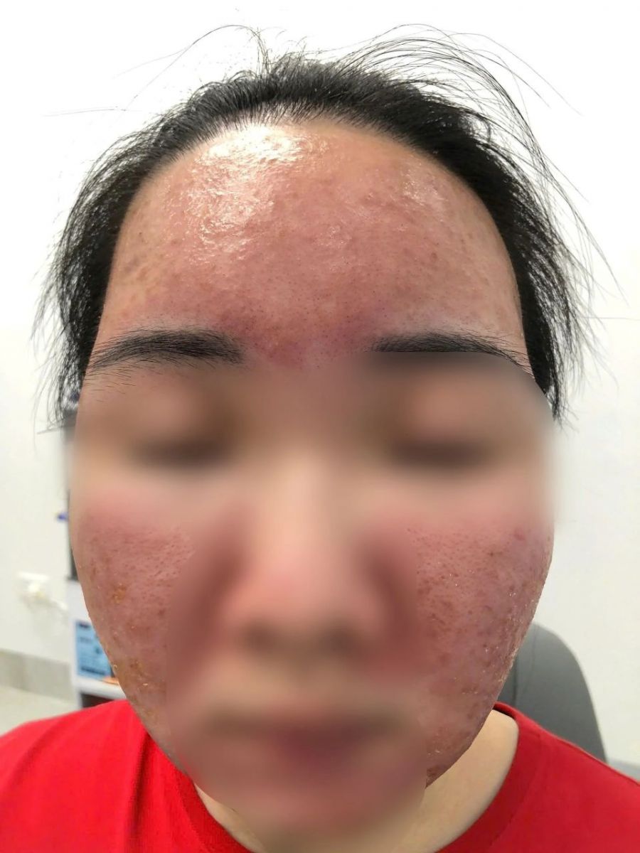 Hỏng da vì dùng kem "SPF 70 siêu chống nắng" mua trên mạng