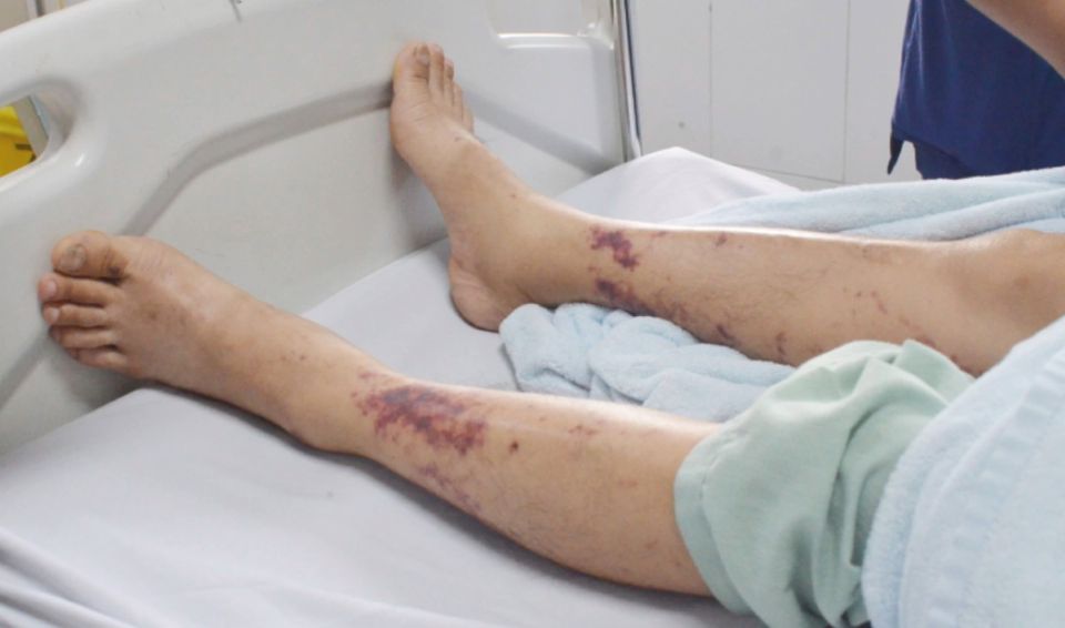Số ca mắc liên cầu lợn tăng bất thường, cần làm gì để phòng tránh?