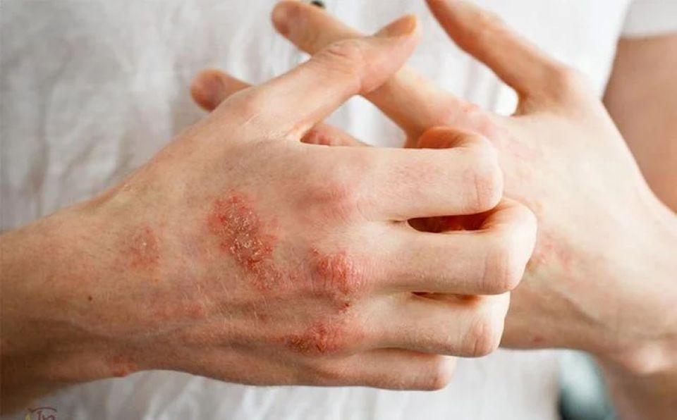 Cách điều trị và phòng ngừa bệnh ghẻ trong mùa mưa bão, lũ lụt